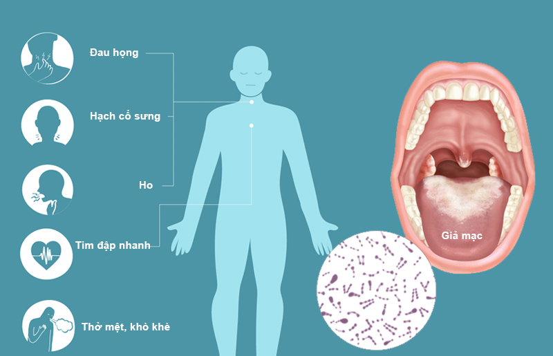 Triệu chứng bệnh bạch hầu